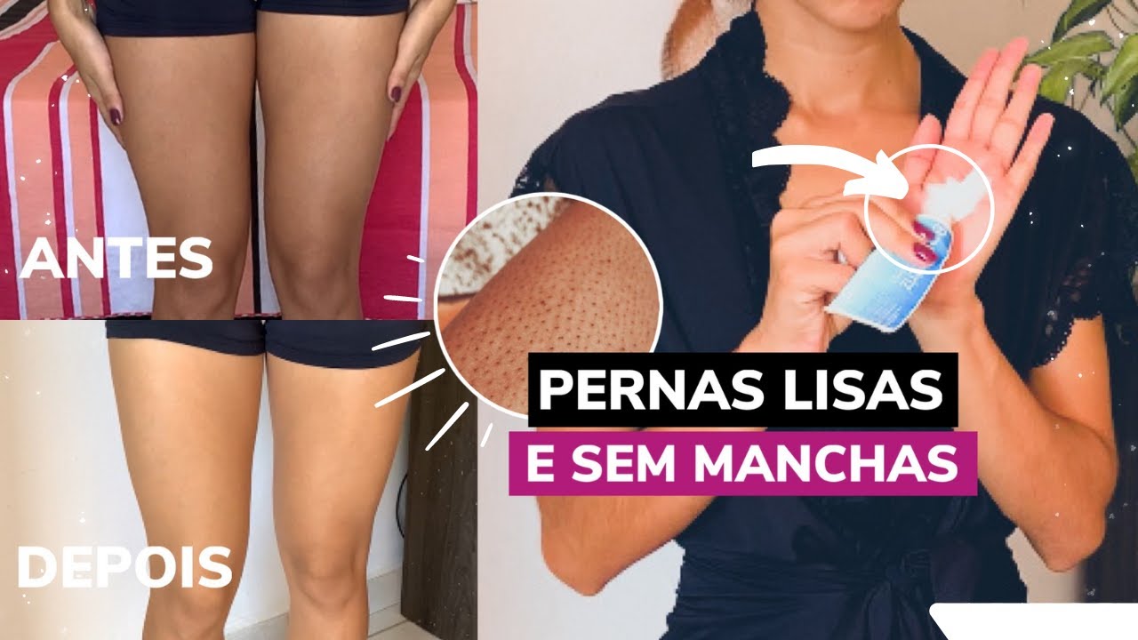 De pernas pro ar: pernas lisinhas com depilação a laser