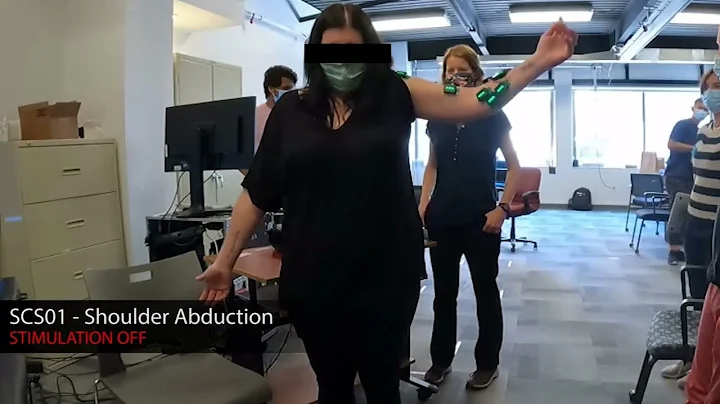 Spinal cord stimulation instantly improves arm mobility after stroke