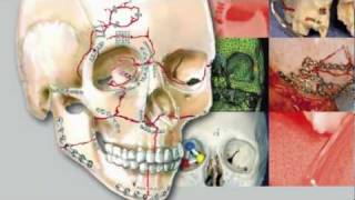 Craniomaxillofacial Buttresses: Anatomy and Operative Repair screenshot 5