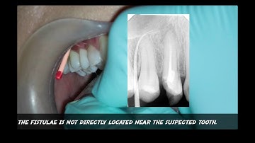 Tracing Sinus Tract With Gutta Percha Point TAKEN WITH XRAY IMAGE apical abscess tooth fistulae