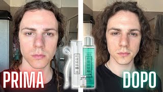 Ho Testato Il DERMAROLLER Per 3 Mesi Per Curare Le Mie Cicatrici dell'Acne