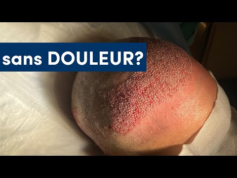 Comment fonctionne une greffe de cheveux indolore ? l Elithair