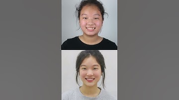 Khắc phục tình trạng răng móm bằng phương pháp niềng răng | Lạc Việt Intech Niềng Răng #shorts