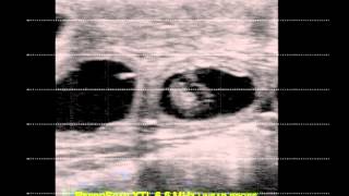 38 day pregnancy test with ReproScan XTL 6.5 MHz linear probe screenshot 5