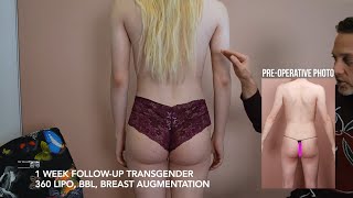 1 Week Post-Op  | Gender Affirming Surgery: 360 Lipo + BBL & (MTF) Breast Augmentation Results