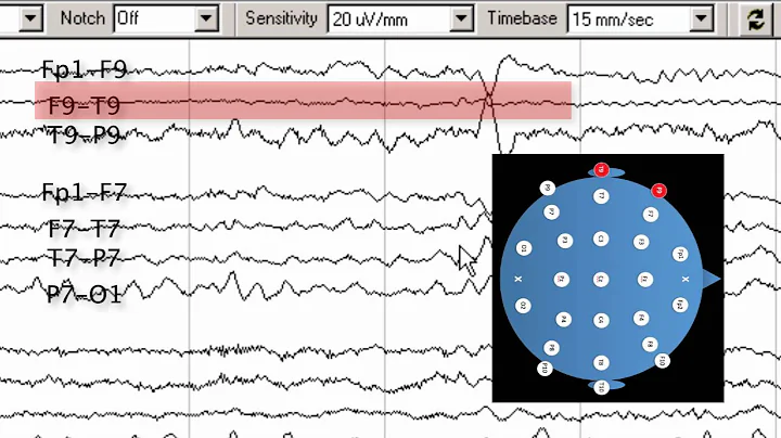 8   interictal abnormalities