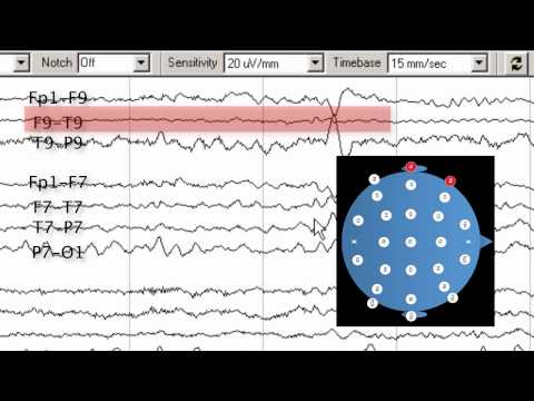 8   interictal abnormalities