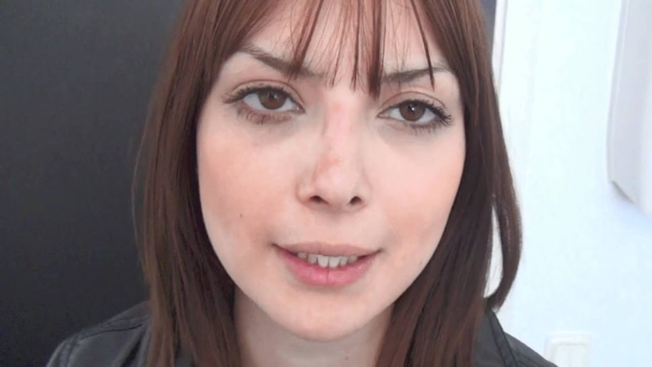 Näsplastik 28 efter 4 månader Primakliniken Plastikoperationer Rhinoplasty