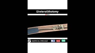 Ureterolithotomy 💉💊🩹🩺