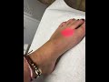 Female feet laser hair removal