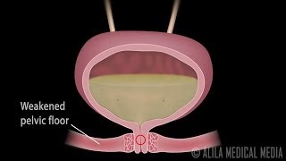 This video is available for licensing with immediate download here :
https://www.alilamedicalmedia.com/-/galleries/all-animations/urinary-system-videos/-/med...