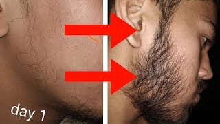 The REAL Patchy Beard Fix (Proof given by my own Subscriber!) | Only the truth [HINDI]