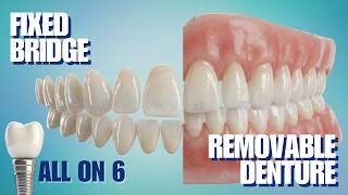 Implant Treatment Guide in Turkey: Temporary Teeth - Dr. Taslidere Explains