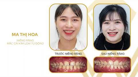 Khắc phục triệt để răng thưa với niềng răng mắc cài kim loại | Nha khoa Win Smile