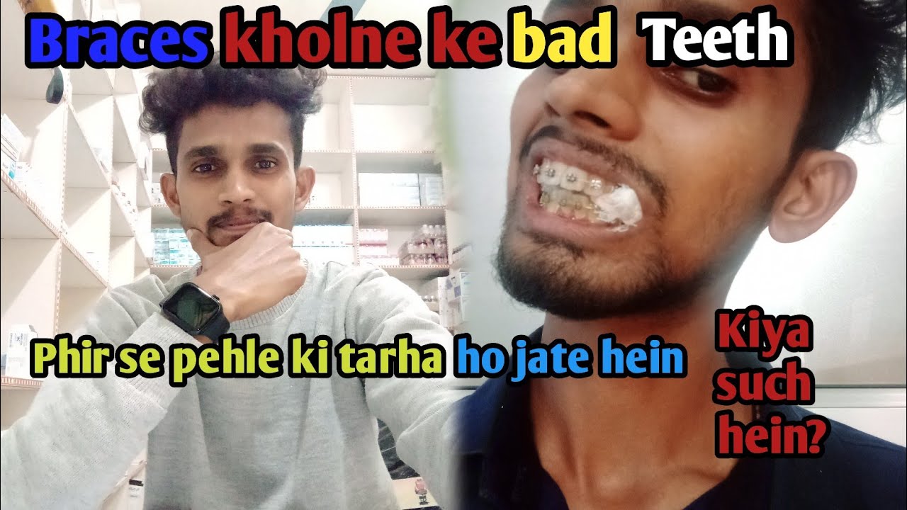 Braces खोलने के बाद दाँत पहले जैसे क्यों नहीं रहते? पूरी सच्चाई जानें!