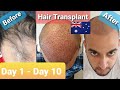Day 1 - Day 10 | FUE 1800 Graft | Daily Update | Hair Transplant Sydney | Australia |