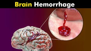 What Happens in Brain Hemorrhage? | Symptoms, Causes and Treatment (Urdu/Hindi)