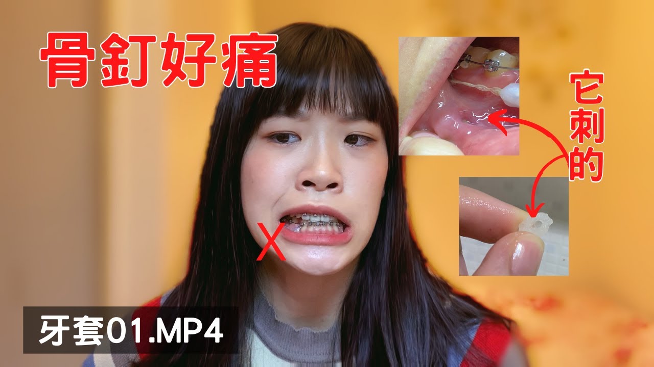打骨釘後到底要怎麼正常生活？？這是疑問不是有解答...救命好痛。｜牙套日記01