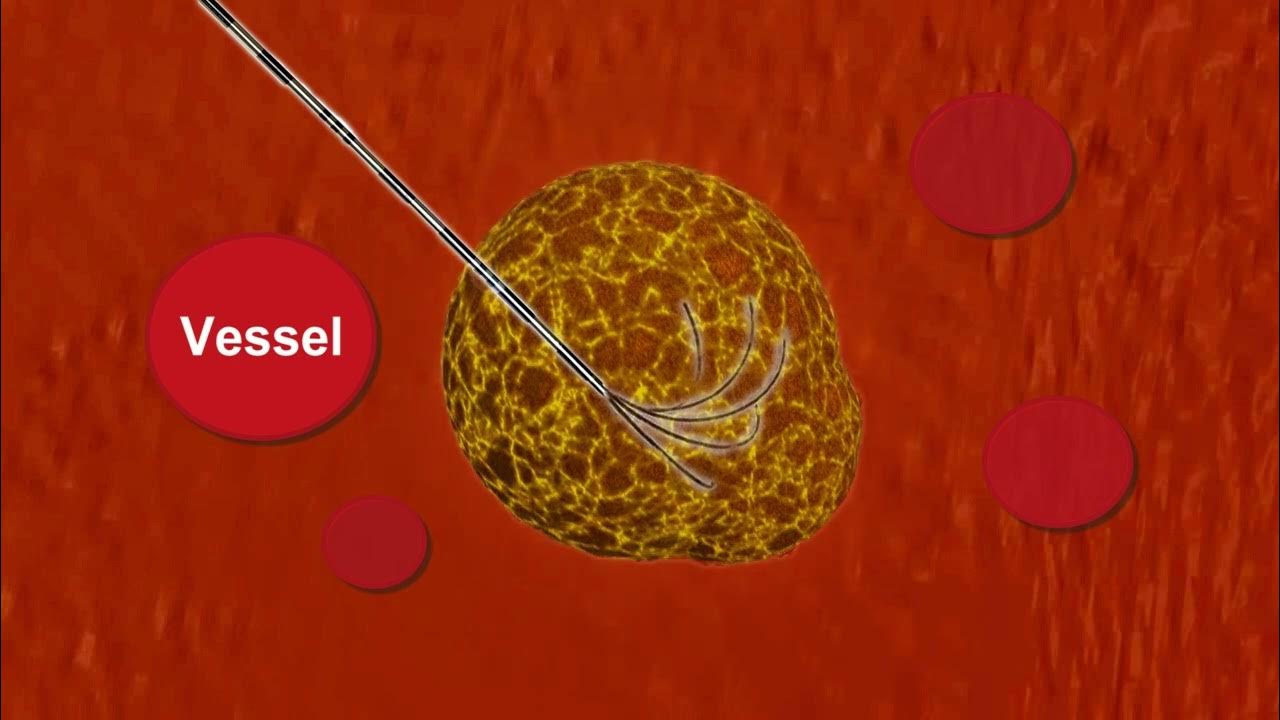 Intelligent Radio Frequency Ablation (iRFA) YouTube