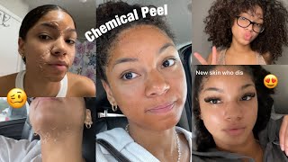 my first chemical peel | hstanesha
