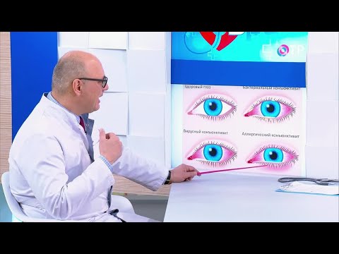 Видео: Конюнктивит на окото при възрастни - лечение, симптоми