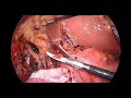 Câncer Gástrico Piloro. Gastrectomia distal VLP com linfadenectomia + Verde indocianina