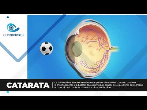 CLINSBORGES - CATARATA