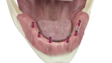 Implant CompressiveM. Intra oral welding.