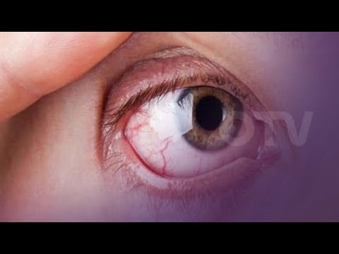 فيديو: هل يمكن أن يسبب العمى الليلي جفاف العين؟