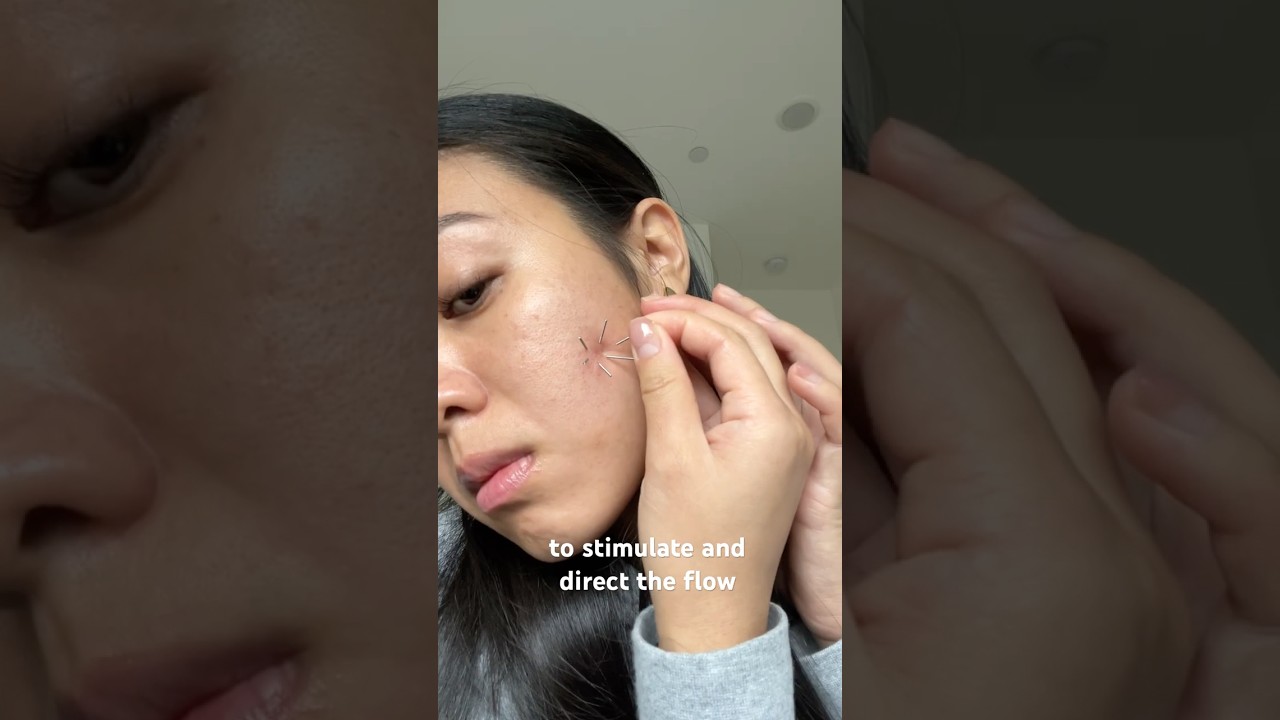 Facial acupuncture for acne and dark spots.