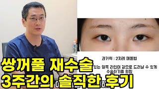 쌍꺼풀재수술 3주간의 솔직후기(매몰법 재수술,회복기간)