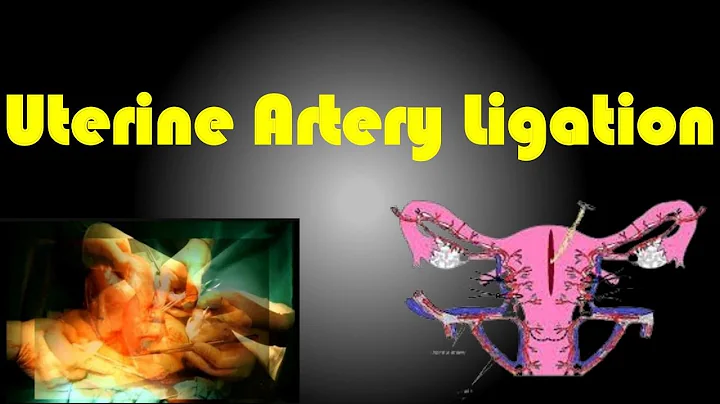 Ligation of the Uterine Artery | Uterine Artery Ligation Procedure