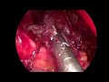 Endoscopic Pectoralis Minor Tenotomy