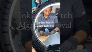Celebrity The Inkless Stretch Mark Removal Experience 💕 Wealth
