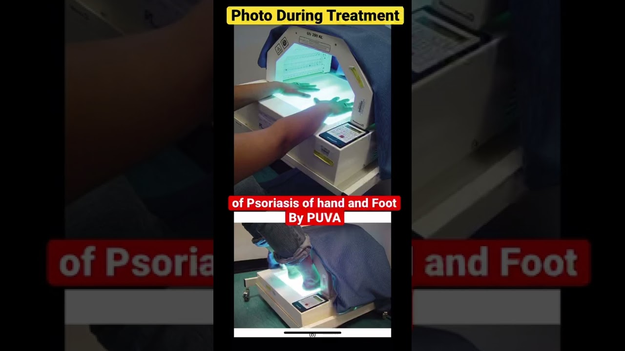 Hand and Foot PUVA Treatment of Psoriasis YouTube
