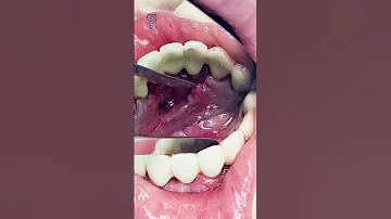 Зубной камень захватил полость рта. Tartar has invaded the oral cavity.