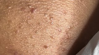 These are oxidized blackheads.