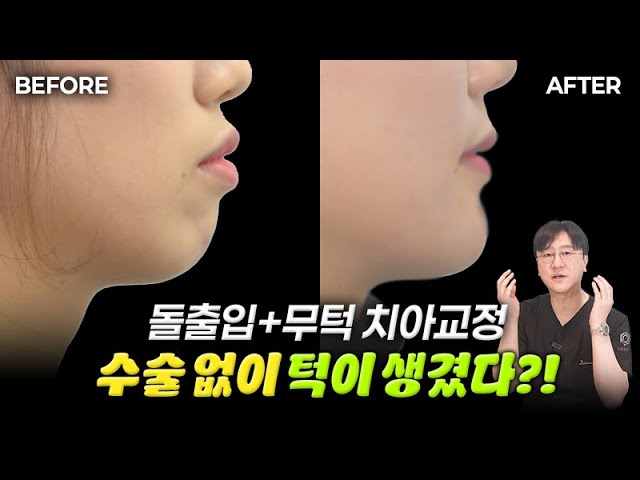 돌출입 교정 수술 없이 몇 년만에 끝날까❓