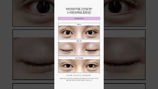 뒤트임부작용 고민일 땐? (+뒤트임복원, 밑트임) #시선성형외과 #shorts