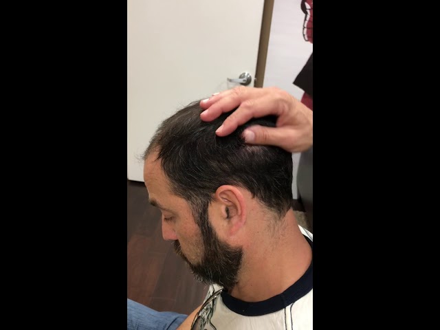 45 year old patient one week after an FUT Hair Transplant Procedure