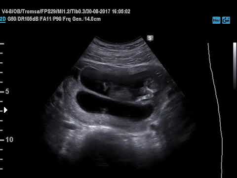 Video: Gravid Med Trillinger: Hvad Man Kan Forvente