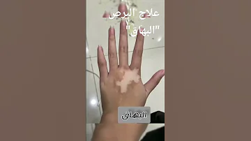 علاج البرص البهاق 