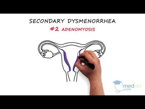 Obstetrics and Gynecology – Dysmenorrhea: By Paul Davies M.D.