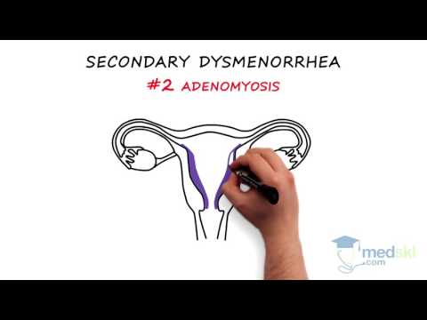 obstetrics-and-gynecology-–-dysmenorrhea:-by-paul-davies-m.d.