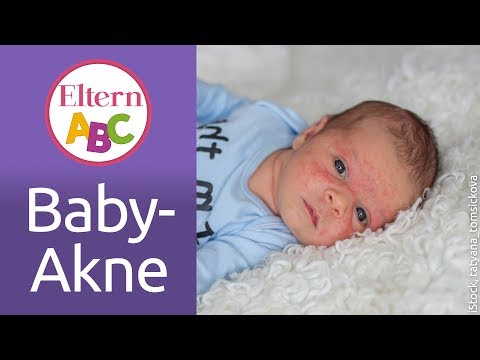 Baby-Akne: Was kann ich tun, wenn mein Kind Baby-Akne hat? | Baby | Eltern ABC | ELTERN