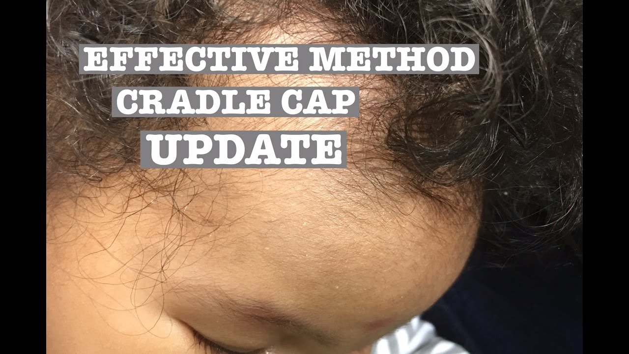 HOW TO GET RID OF CRADLE CAP (Update) YouTube
