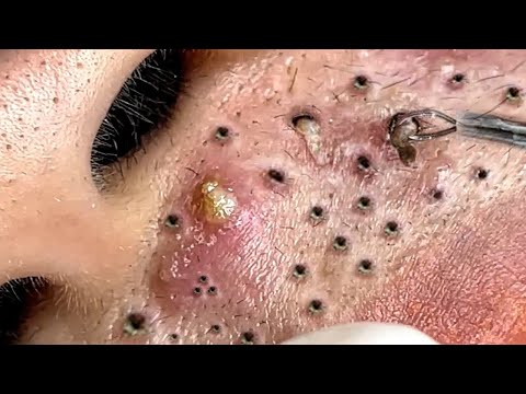 Video Satisfying Relaxing with Thu Huong Spa #377 - youtube