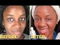 How Long Do Fillers Last? My SECOND Tear Trough Filler Experience!