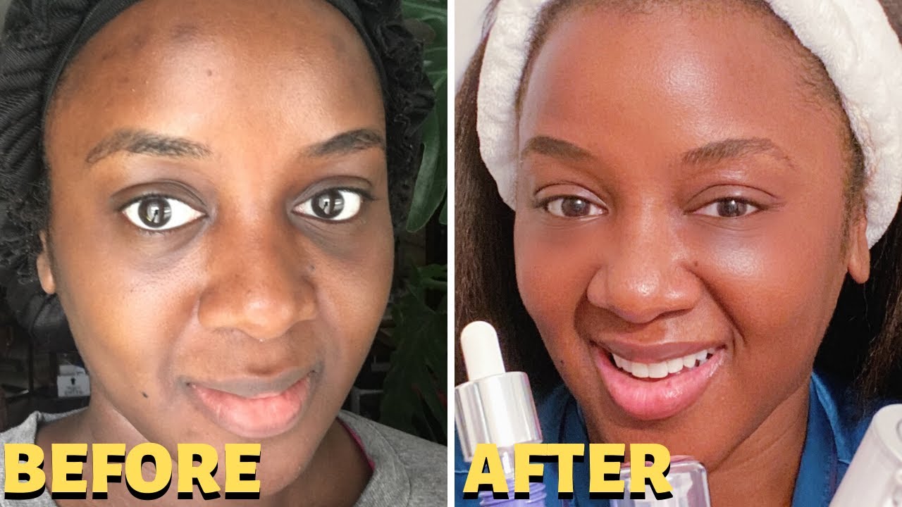 How Long Does Under Eye Filler Last? (Black Skin)