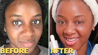 How Long Does Under Eye Filler Last? (Black Skin) Filler Under Eyes Before After